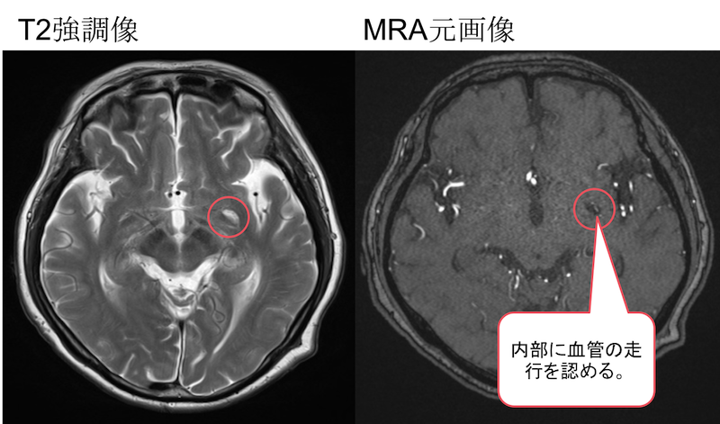 脳MRIで見られる血管周囲腔とは？画像のポイントは？
